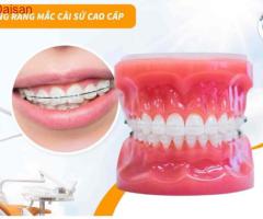 Niềng răng mắc cài sứ bao nhiêu tiền?