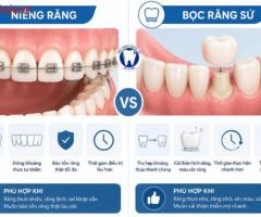 Răng thưa nên niềng hay bọc răng sứ?